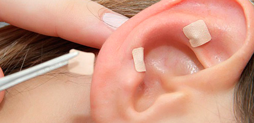 Read more about the article Auriculoterapia ou terapia auricular